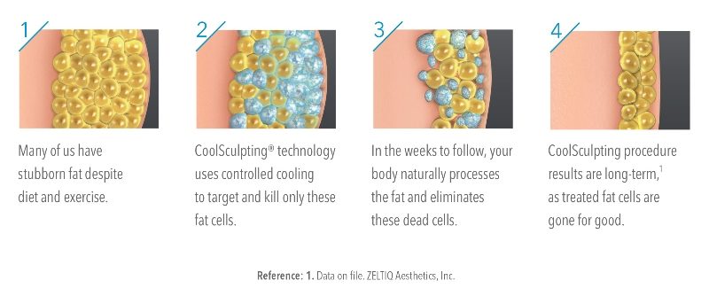 Docere Coolsculpting How it Works