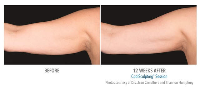 Coolsculpting Before and After Arm