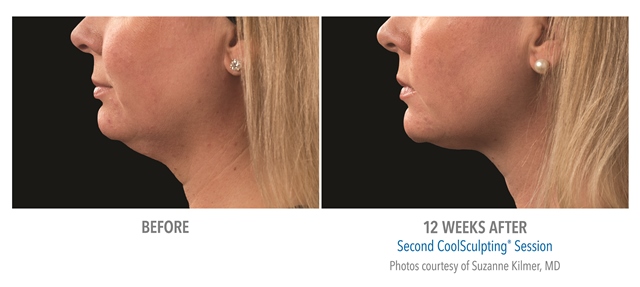 Coolsculpting before and after face
