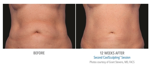 coolsculpting before and after belly