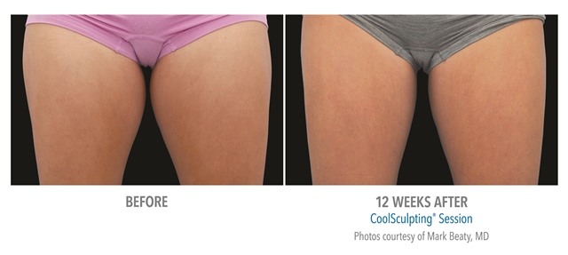 Coolsculpting before and after thighs