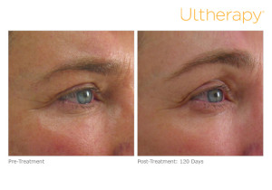Ultherapy before and after 120 days brow