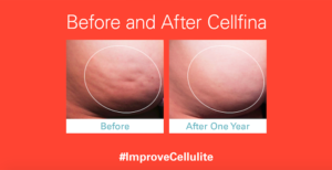 Cellfina before and after