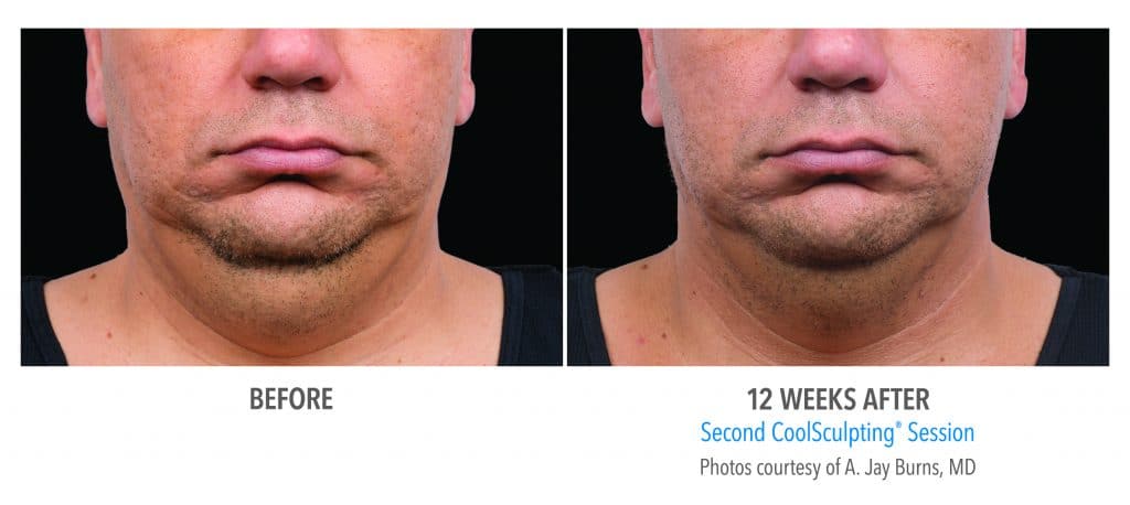 Mans before and after coolsculpting treatment for men at docere medspa, showing chin area.
