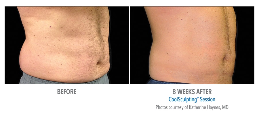 Before and after coolsculpting treatment results showing a mans abdomen in Strongsville, OH.