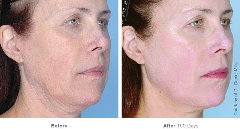 Womans before and after Ultherapy treatment at Docere Medspa.