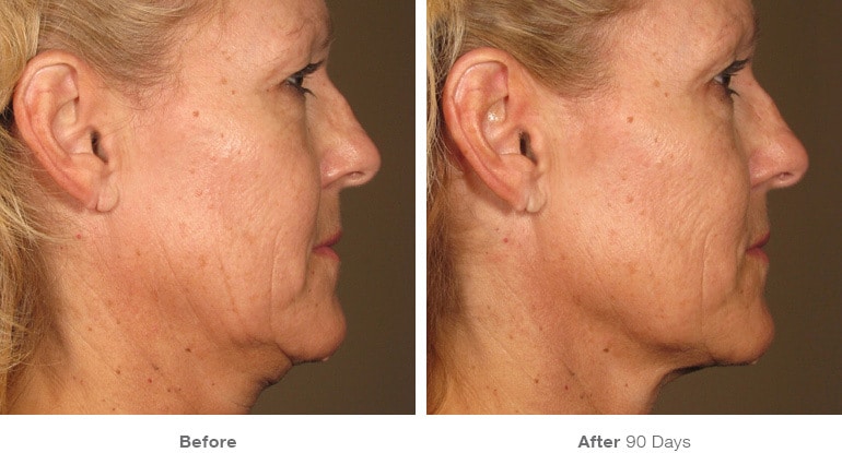 Womans before and after Ultherapy treatment at Docere Medspa.