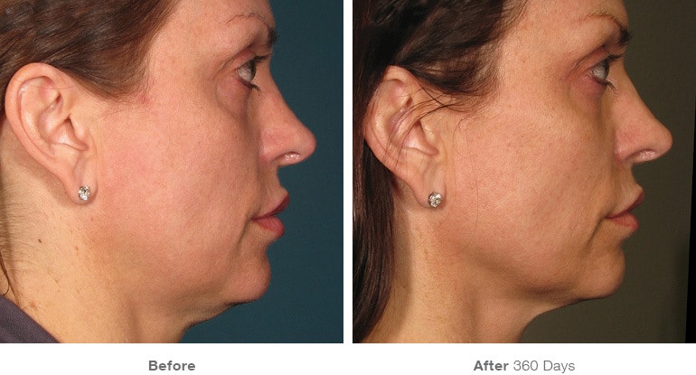 Womans before and after Ultherapy treatment at Docere Medspa.