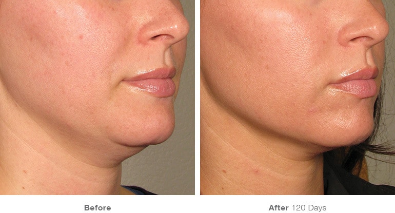 before_after_ultherapy_results_under-chin18