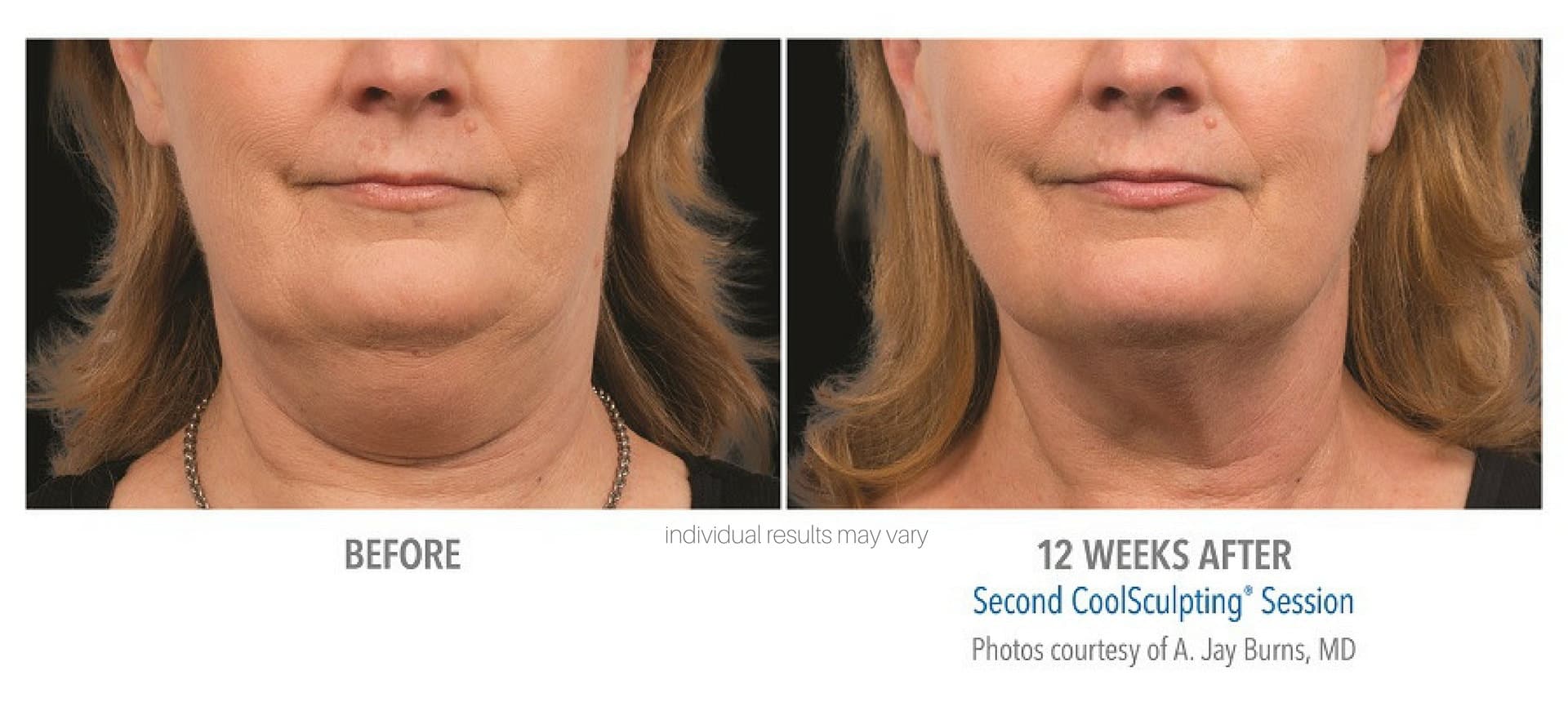 Woman's before and after coolsculpting results from treatment to chin area.