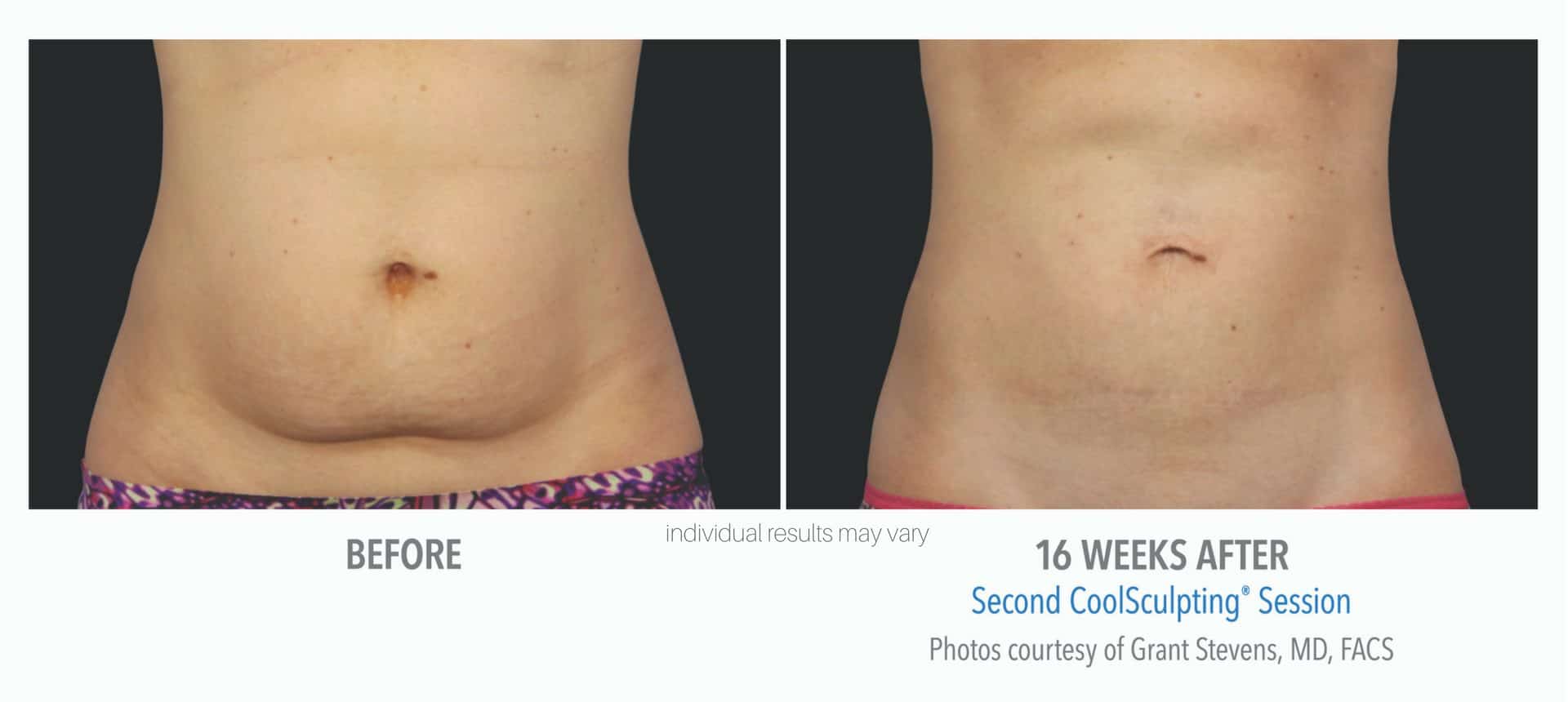 Woman's abdomen before and after coolsculpting treatment.