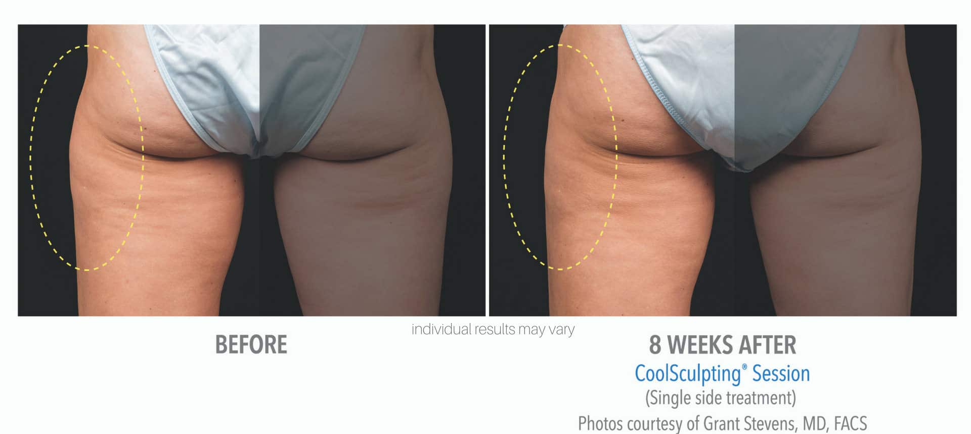 Womans buttocks before and after coolsculpting treatment.