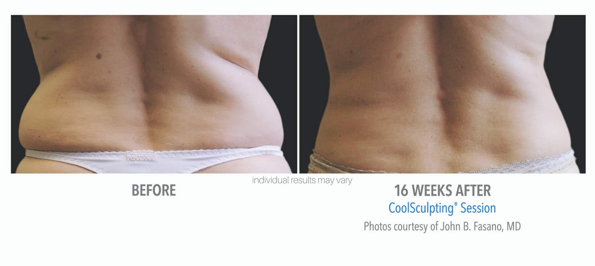 Woman's back before and after coolsculpting treatment.