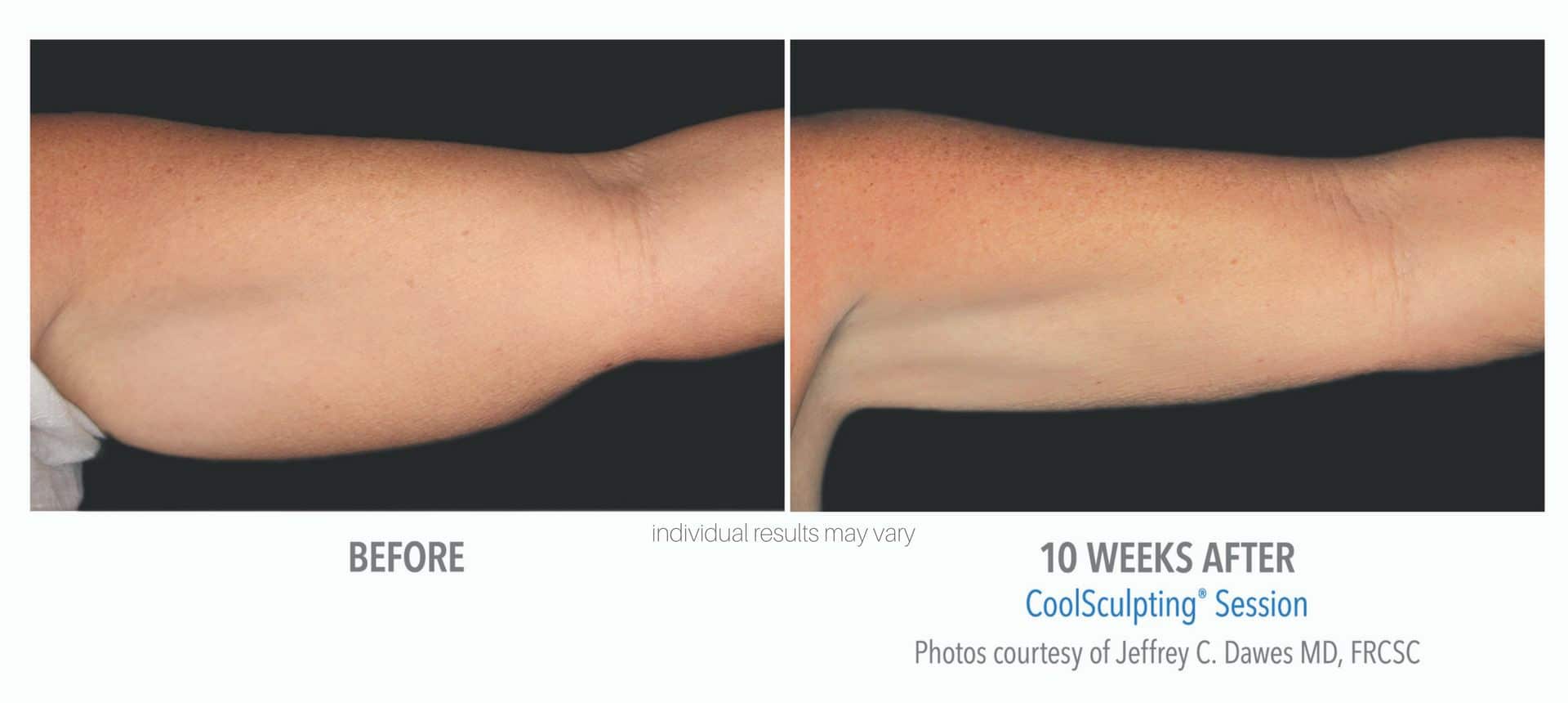 Woman's underarm before and after coolsculpting treatment.