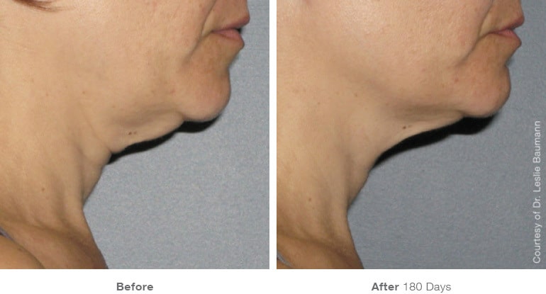 Womans before and after Ultherapy treatment at Docere Medspa.