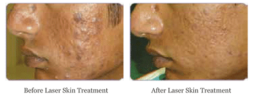 Mans before and after laser skin treatment for acne at docere medspa, offering treatment for men.