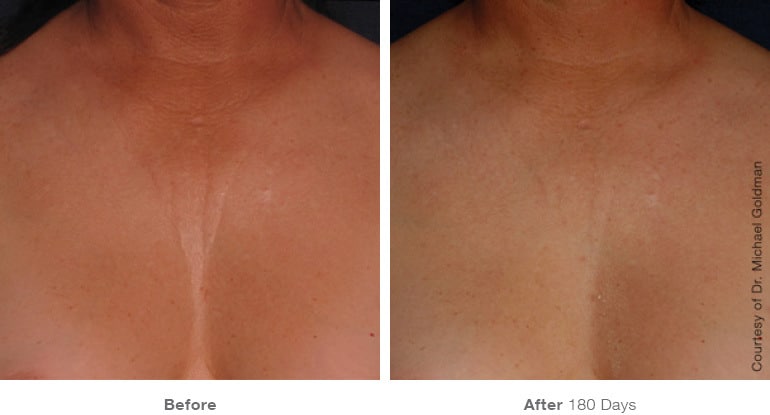 ultherapy-0007-0093ah_180day_1tx_chest_gallery