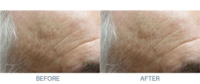Man's before and after results from micro-needling treatment at docere medspa.