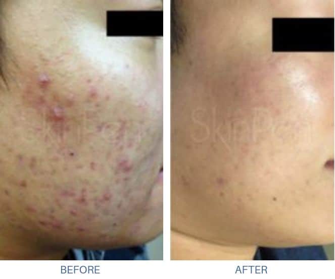 Woman's before and after results from micro-needling treatment at docere medspa.
