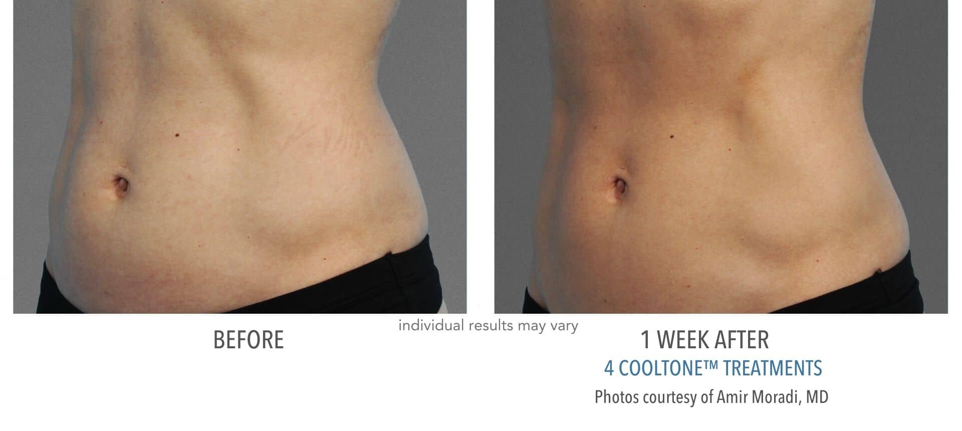 cooltone before and after results on woman's abdomen.