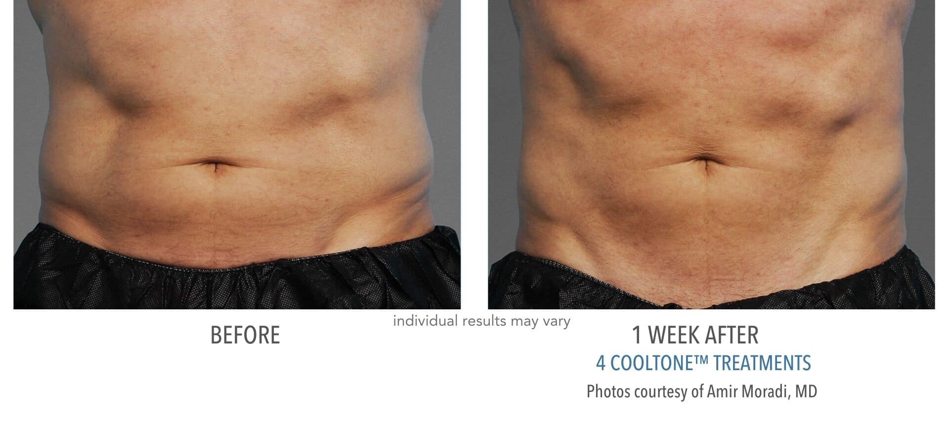 cooltone before and after results to man's abdomen.