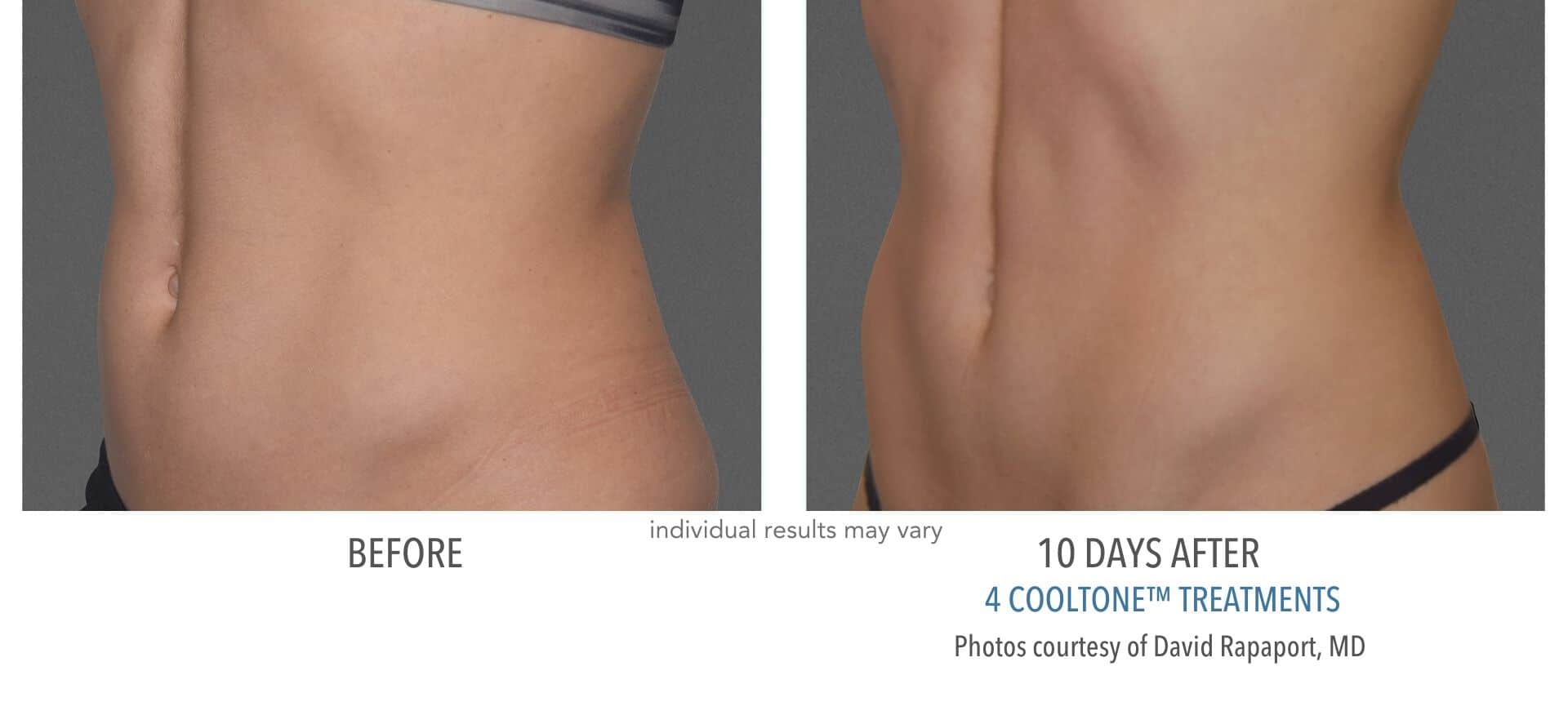 cooltone before and after results of woman's abdomen.