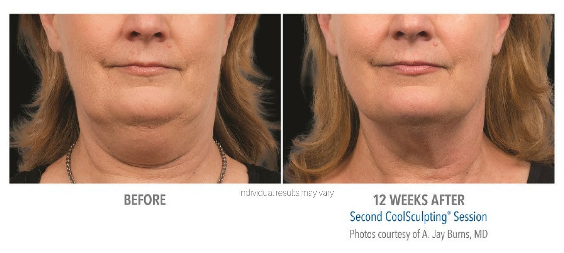 CoolSculpting Before and After, Real Patient Results