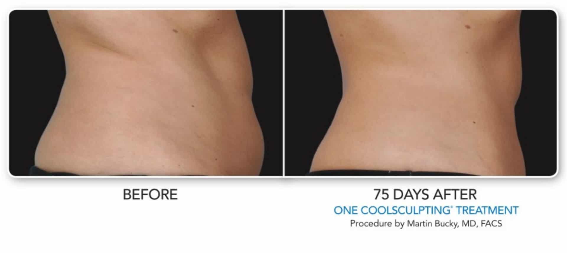 CoolSculpting Before And After Real Patient Results