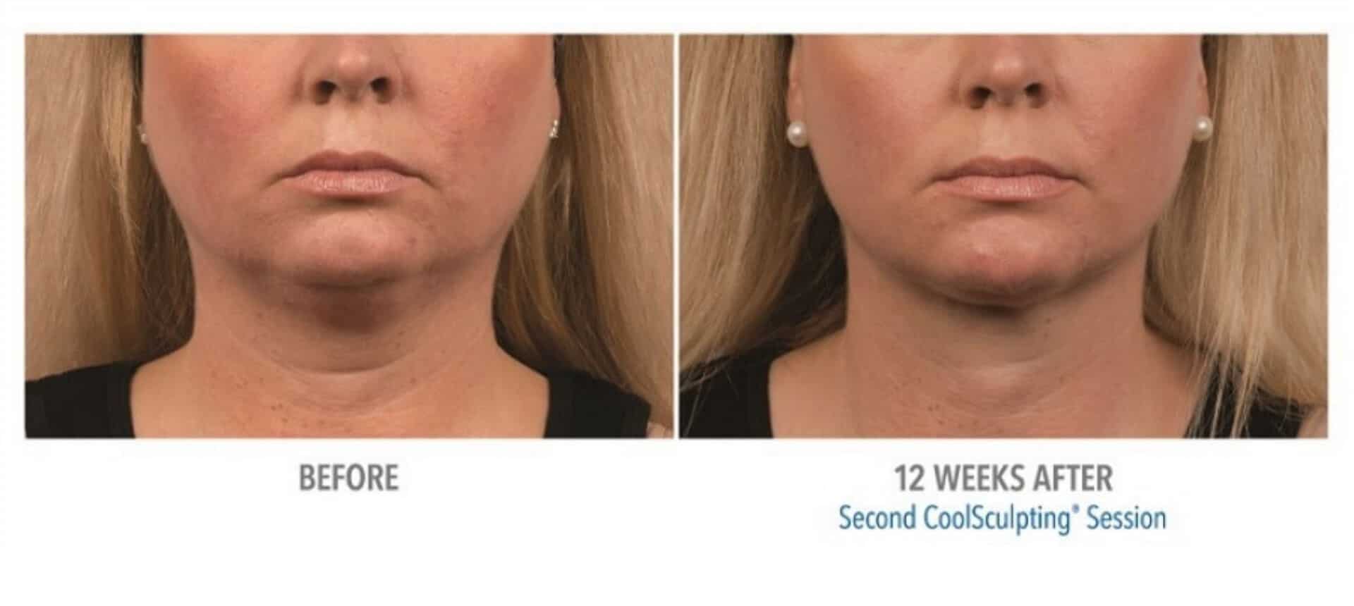 coolsculpting_before_and_after_Docere_Strongsville_3