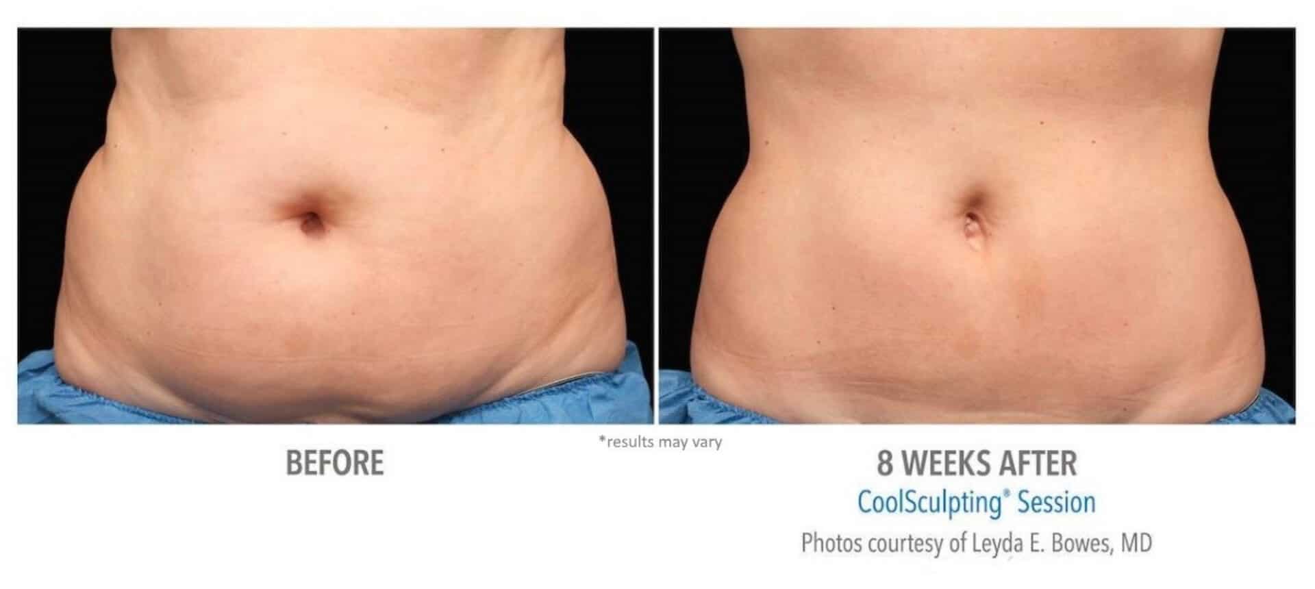 coolsculpting_before_and_after_Docere_Strongsville_5
