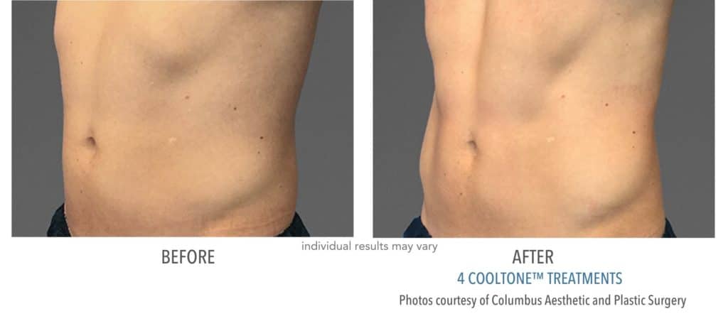 cooltone before and after of man's abdomen.