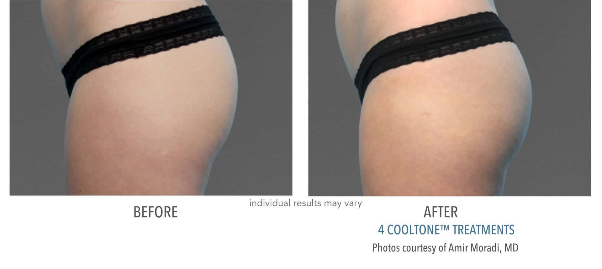 cooltone before and after results of woman's butt.