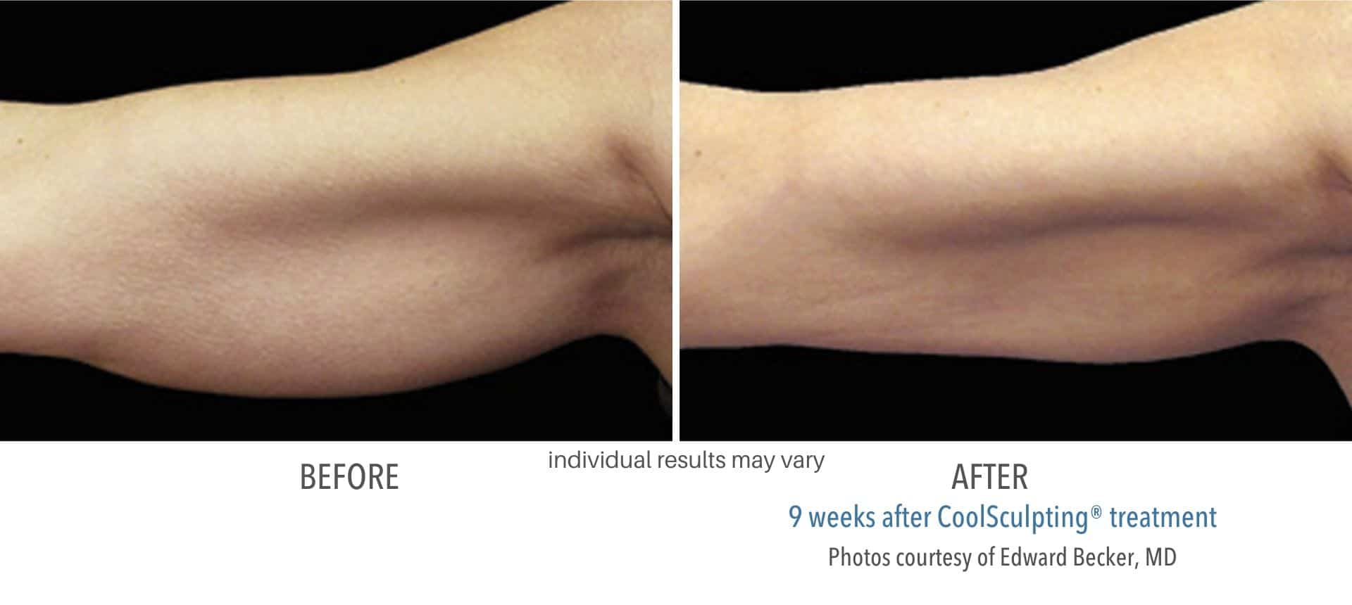 coolsculpting_before_and_after_strongsville_oh_2