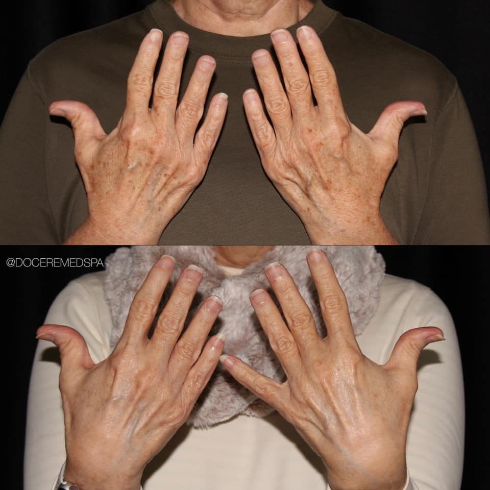 Hands before and after laser skin services at docere medspa.