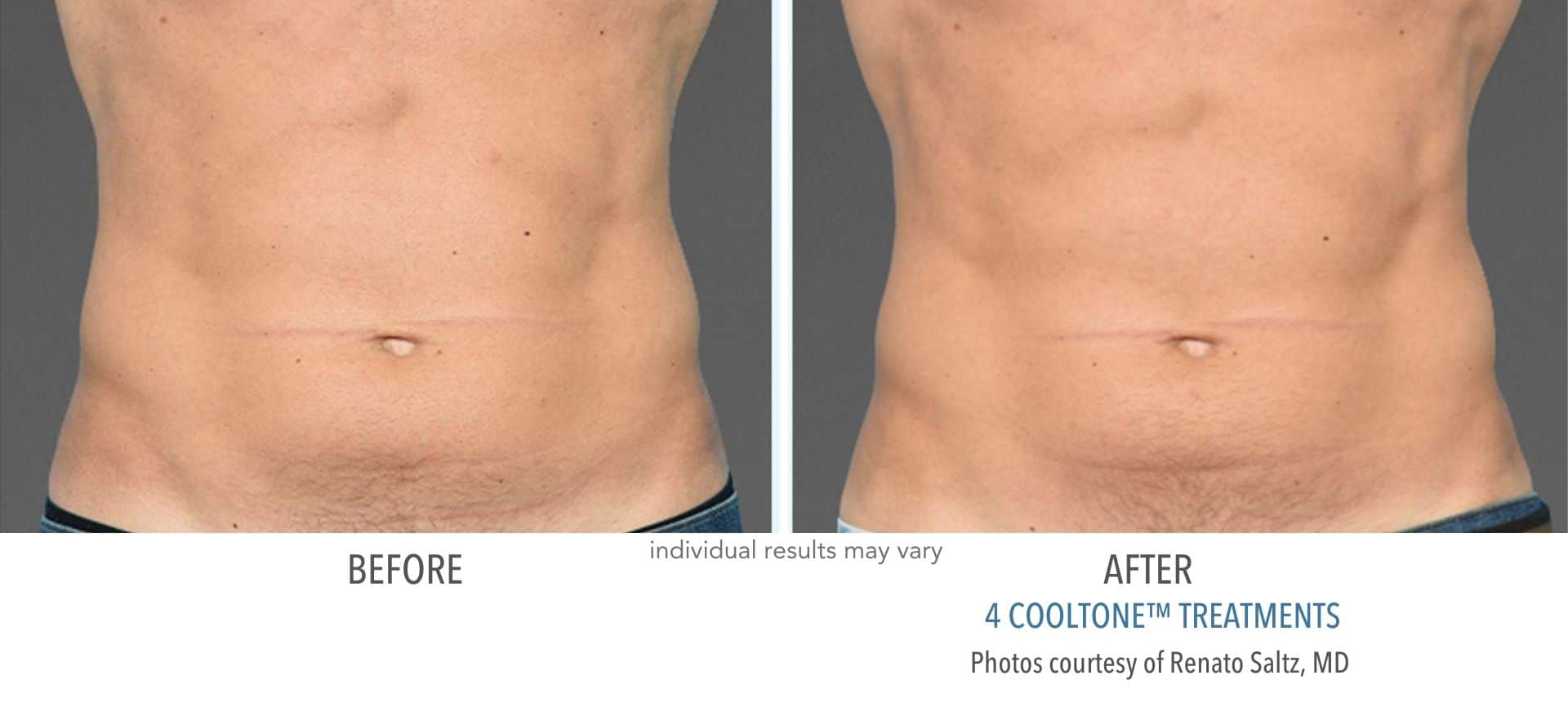cooltone before and after results of Abdomen