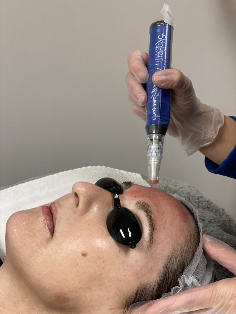 Woman receiving a microneedling treatment at docere medspa..