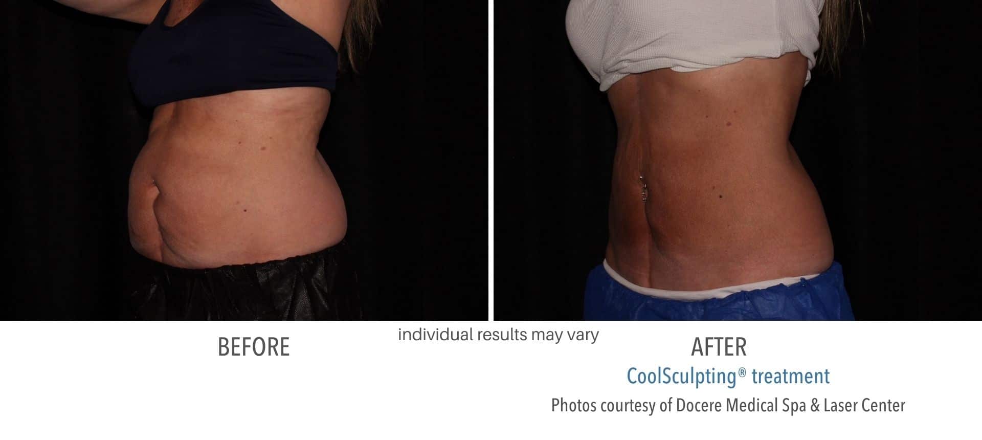 Before and After CoolSculpting treatment from Docere Medical Spa
