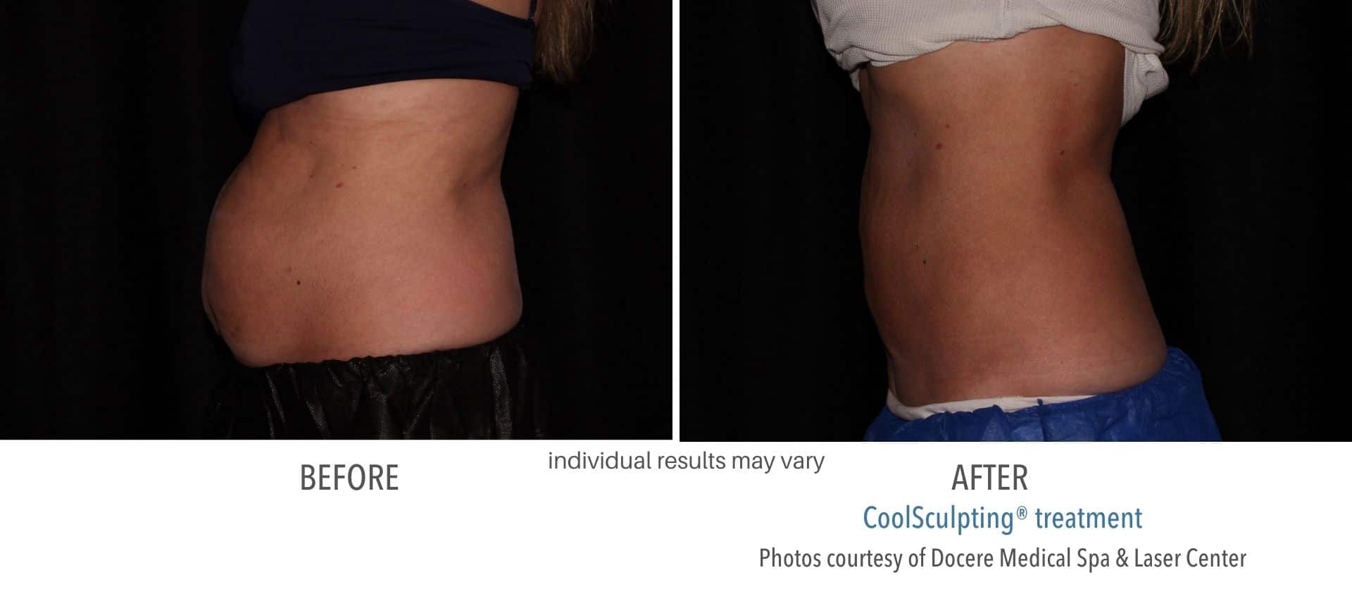 Real patient of CoolSculpting treatment from Docere