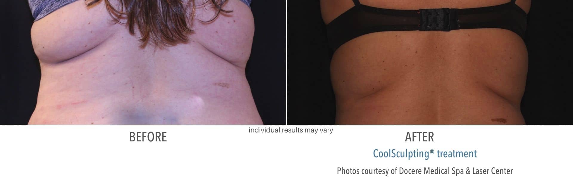 CoolSculpting real patient result from Docere Medspa