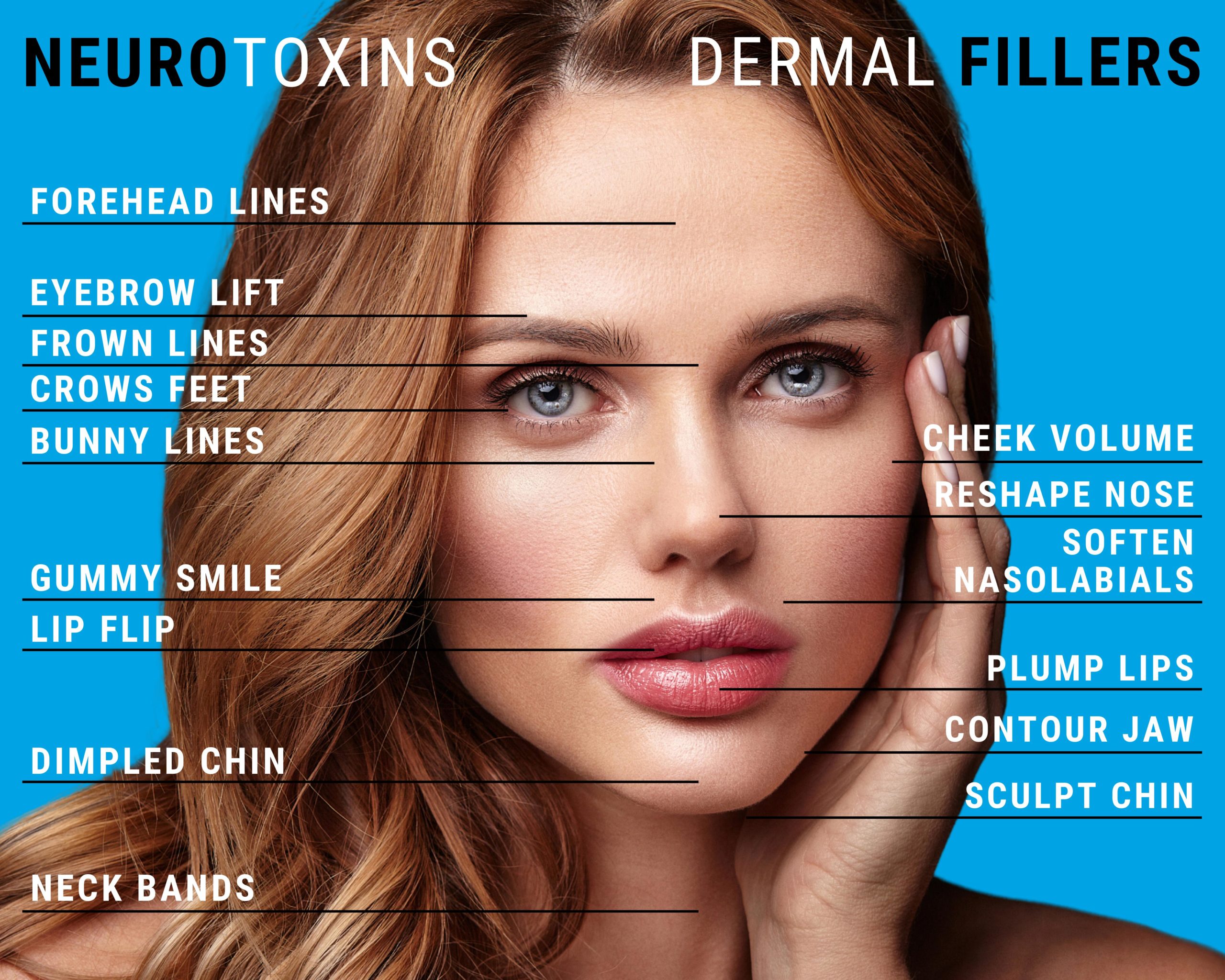 Dermal filler and Neurotoxin treatment area graphic-Strongsville-OH