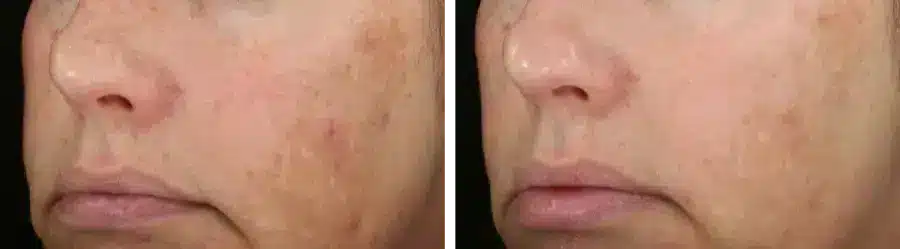 Before and after images of a woman's face showing age spots and discoloration before and clearer, more even skin tone after DiamondGlow Facial treatment in Strongsville.