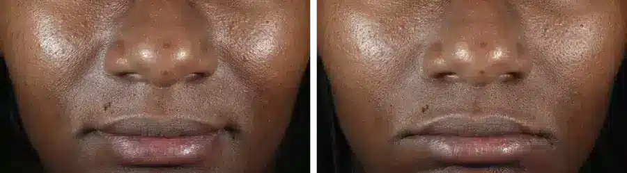 Before and after photos of a woman's face showing blemishes and skin imperfections before DiamondGlow Facial treatment and smoother, clearer skin after DiamondGlow treatment in Strongsville.