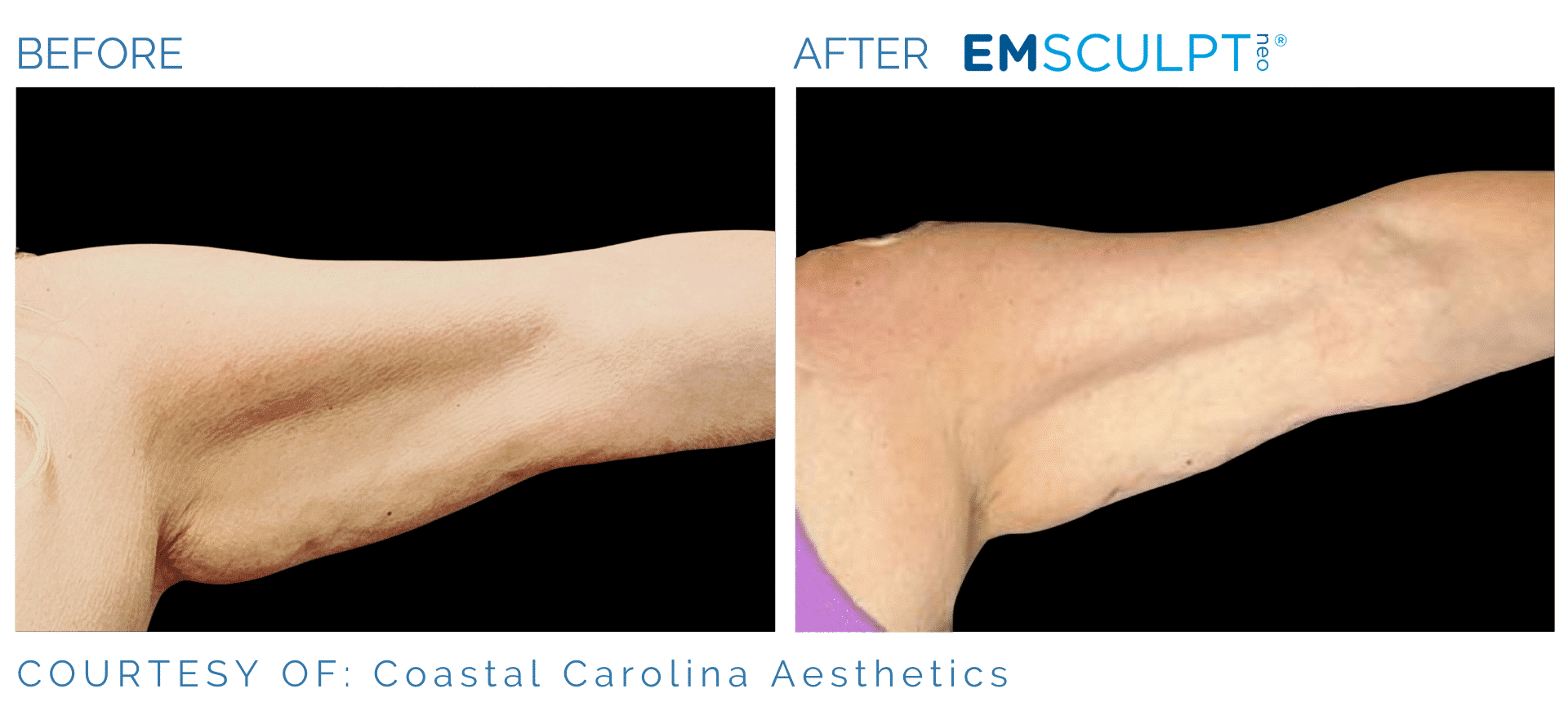Emsculpt NEO Arms Before and After Treament