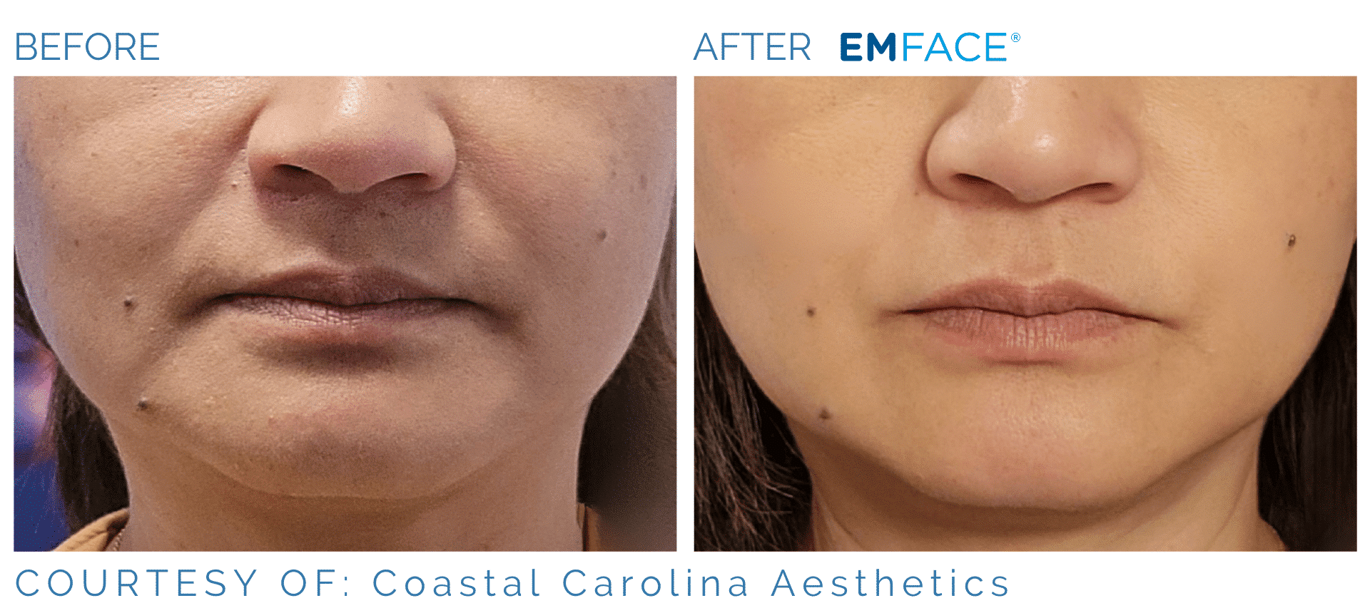 Emsculpt NEO Face Before and After Treament