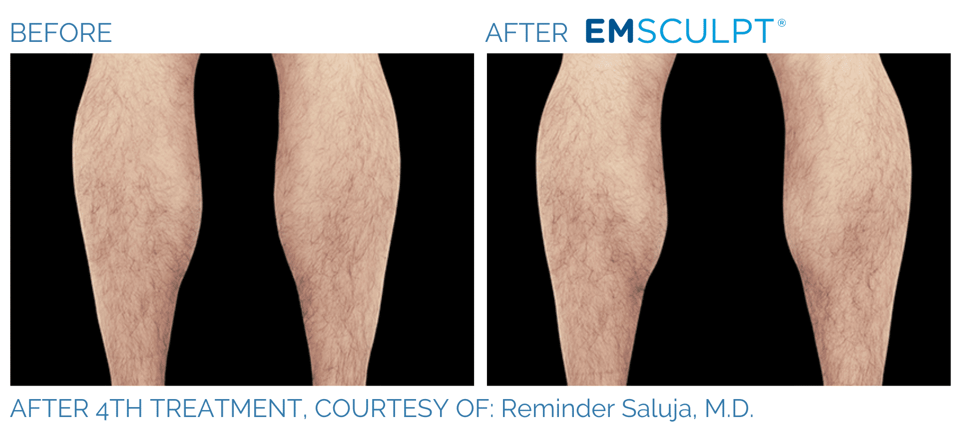 Emsculpt NEO Before and After Treament