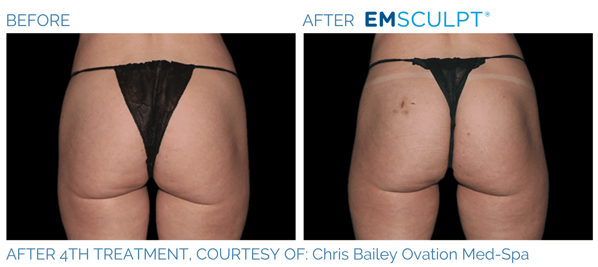Emsculpt NEO Butt Before and After Treament