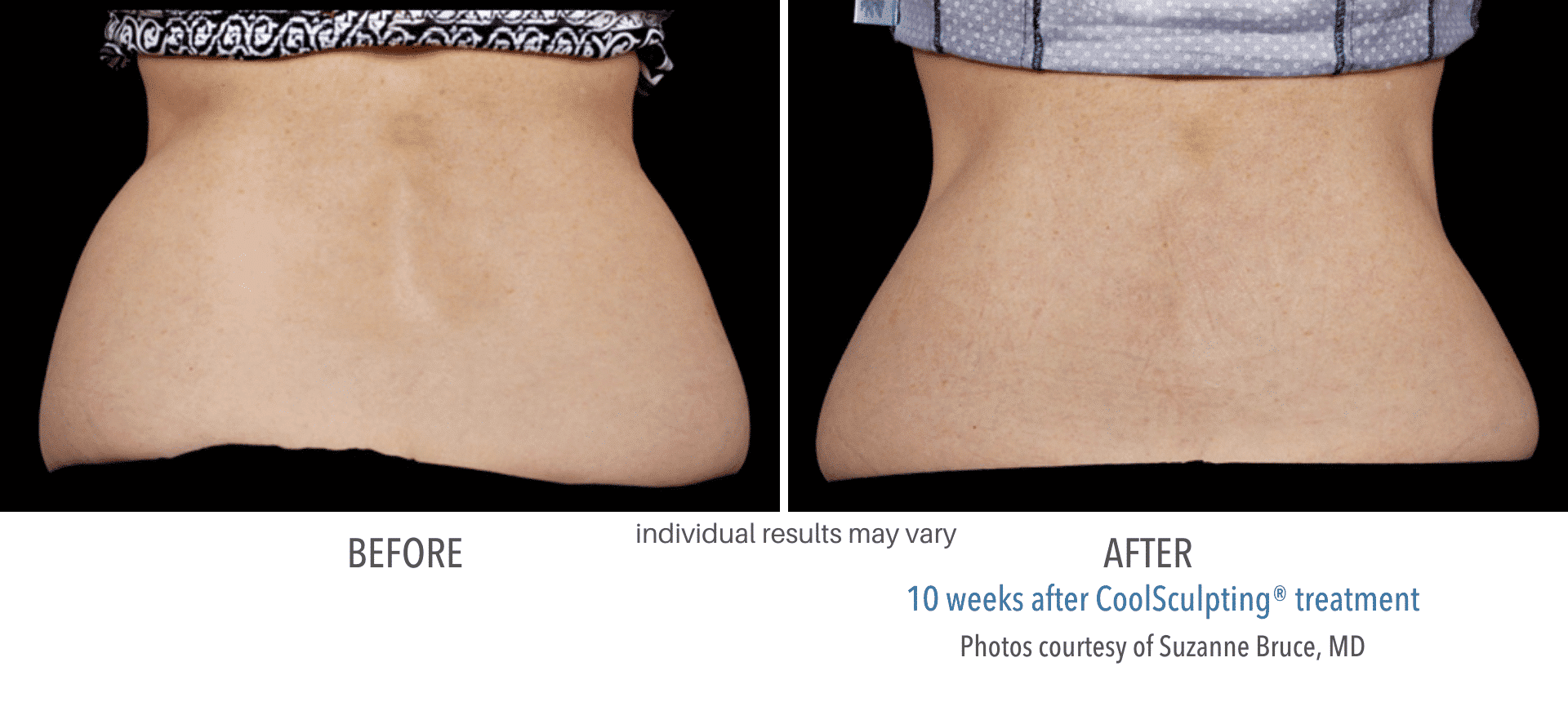 Coolsculpting Before and After0
