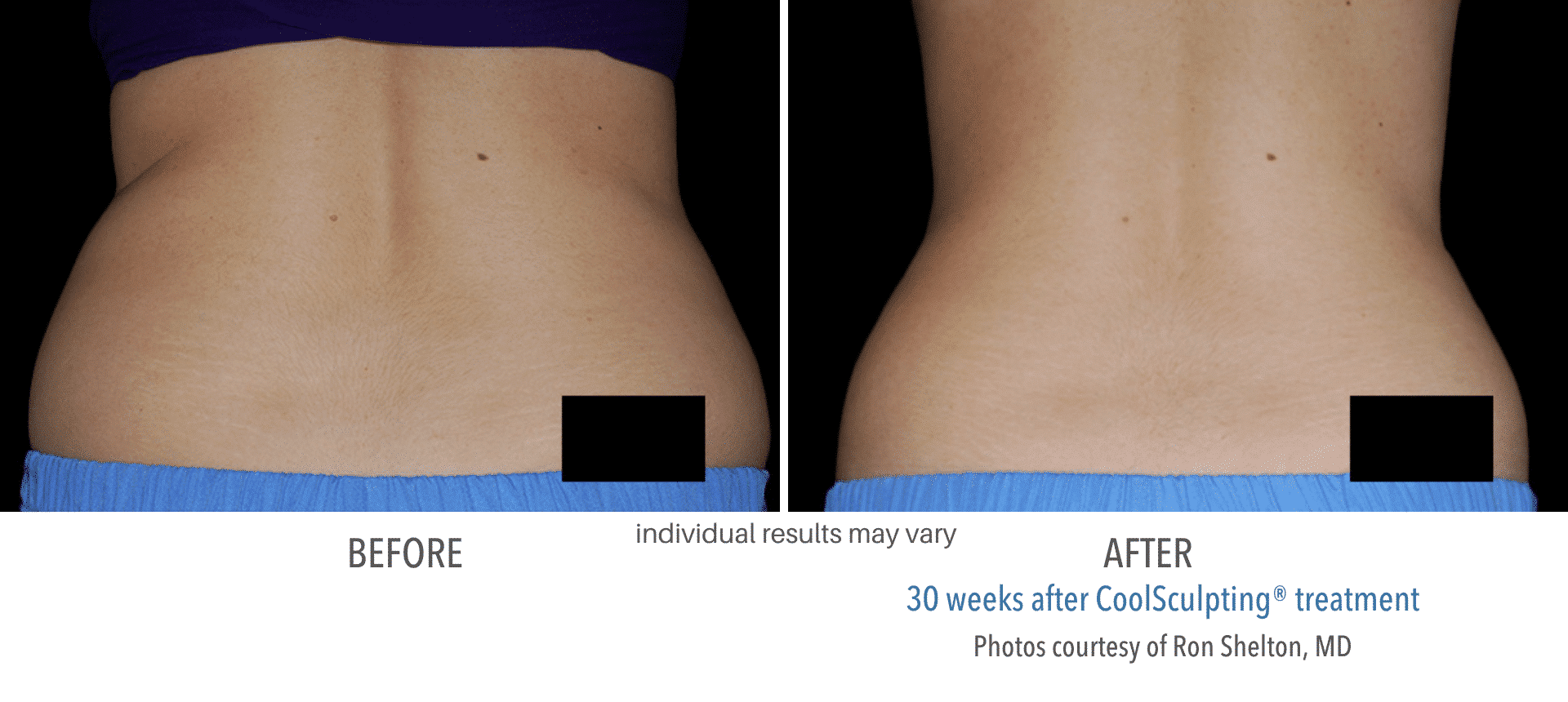 Coolsculpting Before and After1