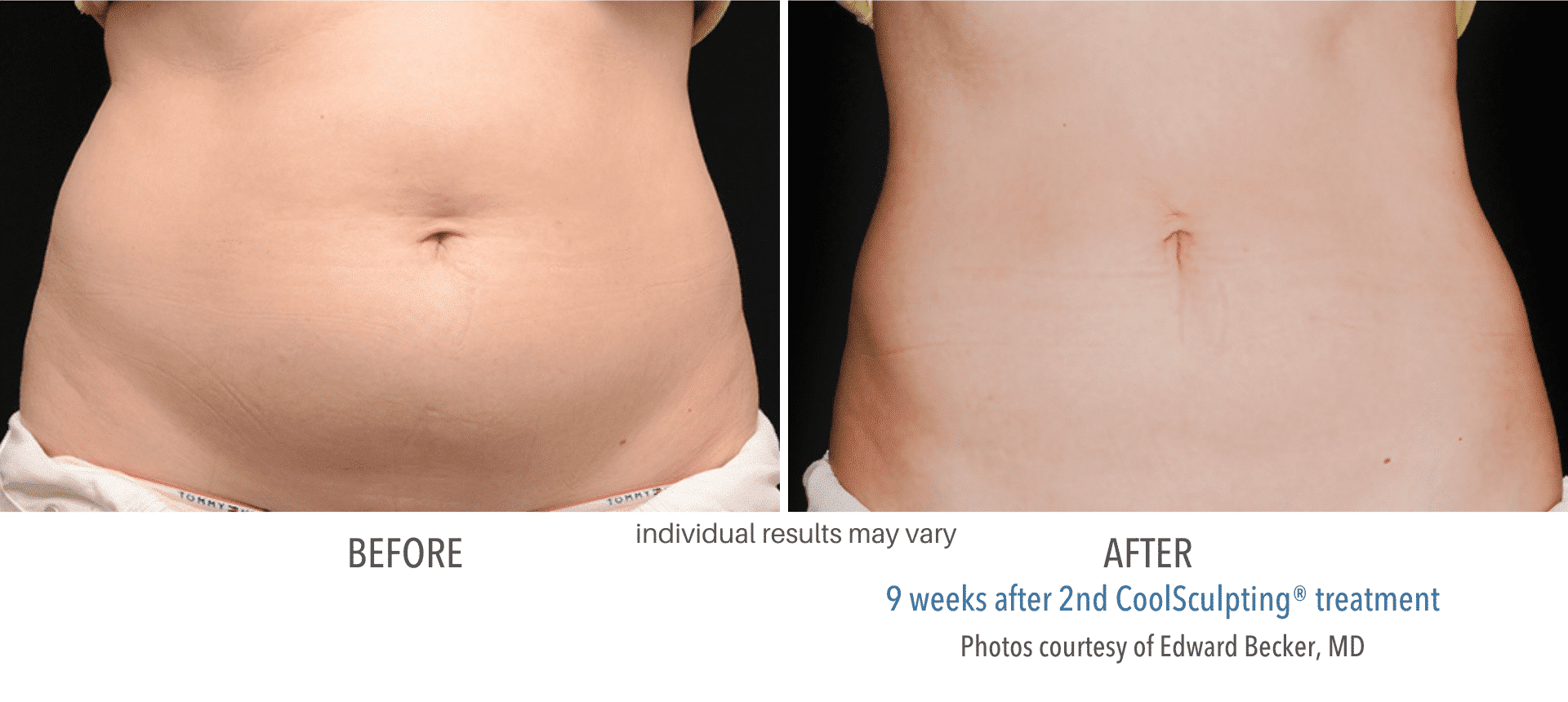 Coolsculpting Before and After2