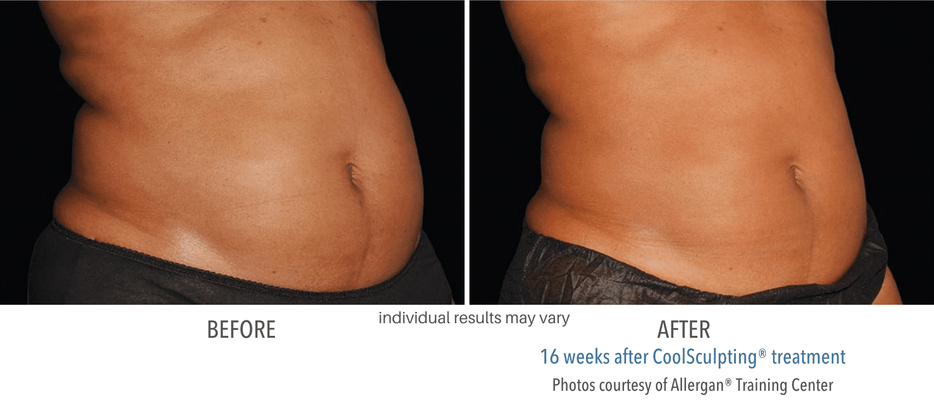 Coolsculpting Before and After3